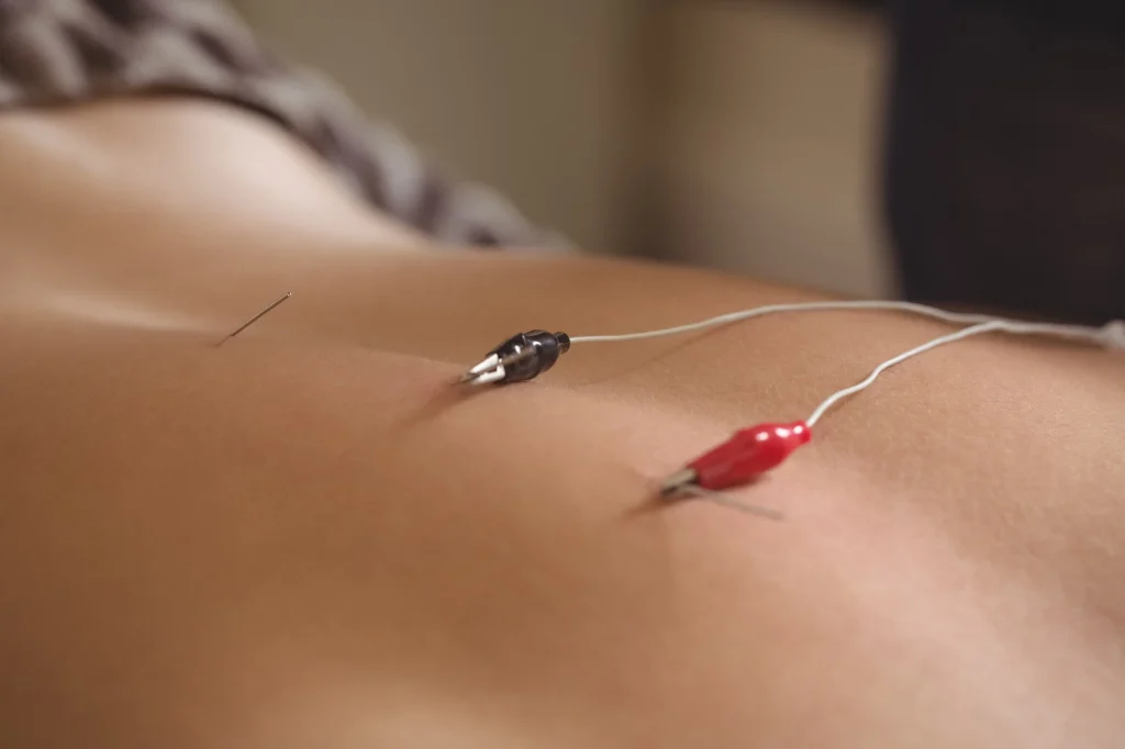 acupuncture wicker park