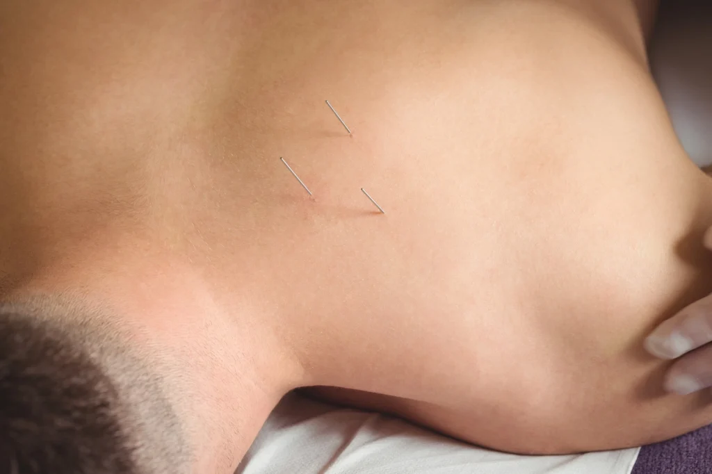 acupuncture in wicker park
